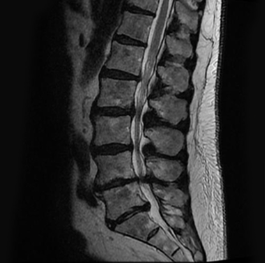 Degenerative disc disease is a common cause of low back pain – SpineAlign