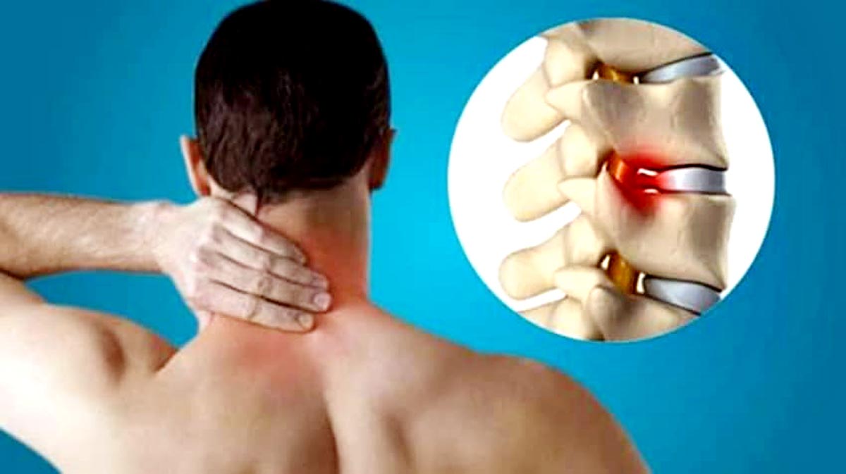 Cervical Spondylosis – SpineAlign